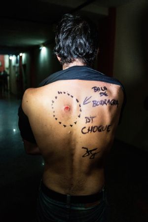 rubber bullet victim