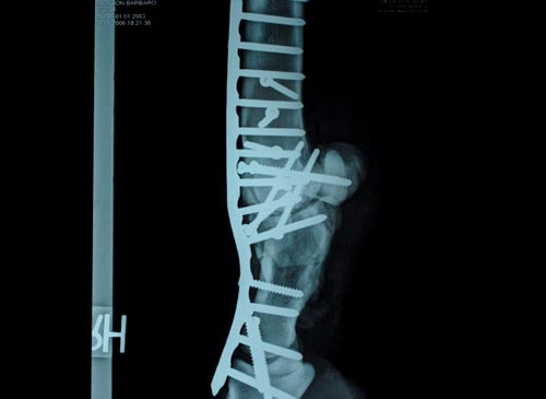 X-rays