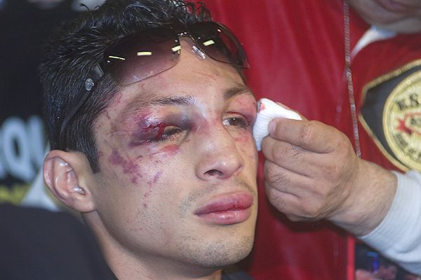 http://a.espncdn.com/photo/2009/0602/box_fw_vazquez_eye_600.jpg