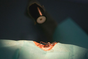Laser Eye Surgery