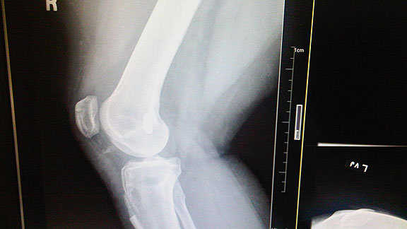 ACL XRay
