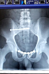 X-Ray