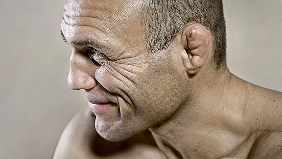 UFC Fighter Randy Couture Is Famous For Cauliflower Ears ESPN The 