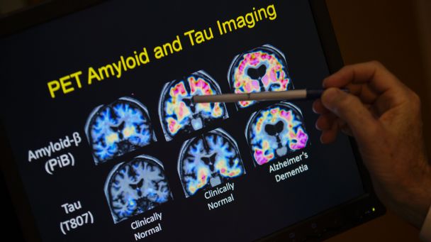 Brain scan