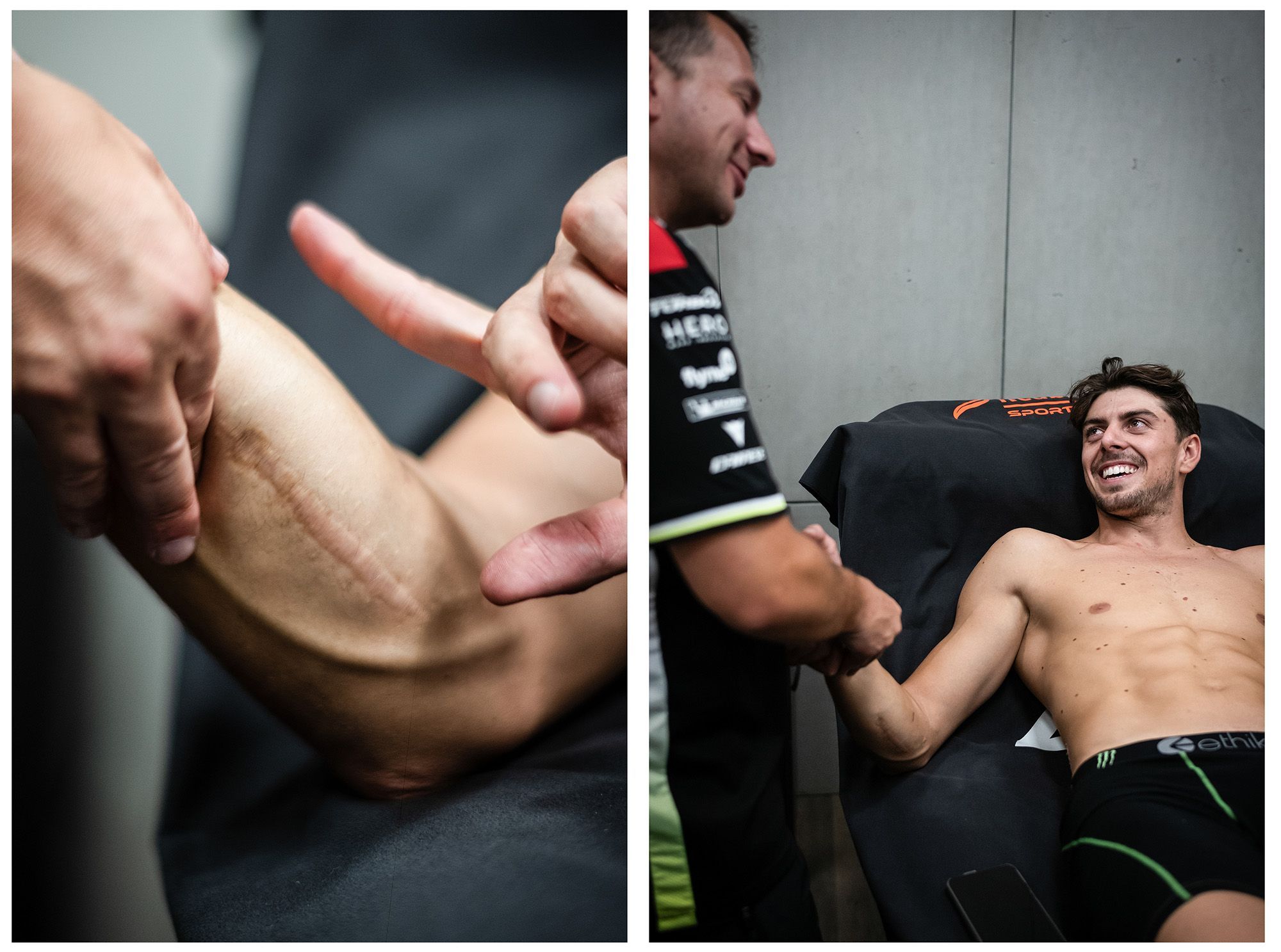 Fabio Di Giannantonio mostrando sus cicatrices de cirugía de arm pump.