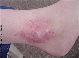 Curt Schilling's ankle