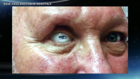 Fan Gets Seahawks Prosthetic Eye Abc7 New York